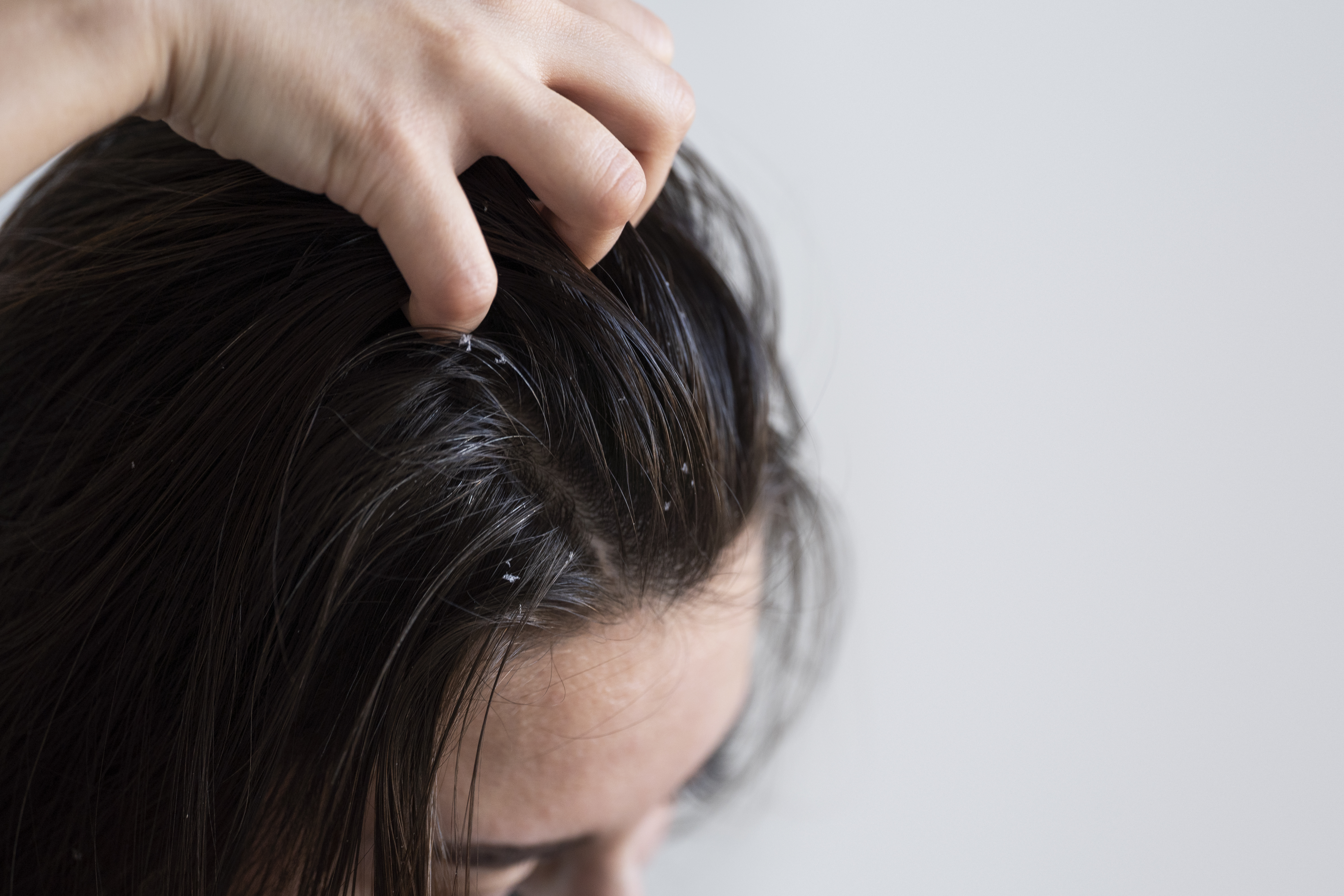 woman-with-itchy-scalp