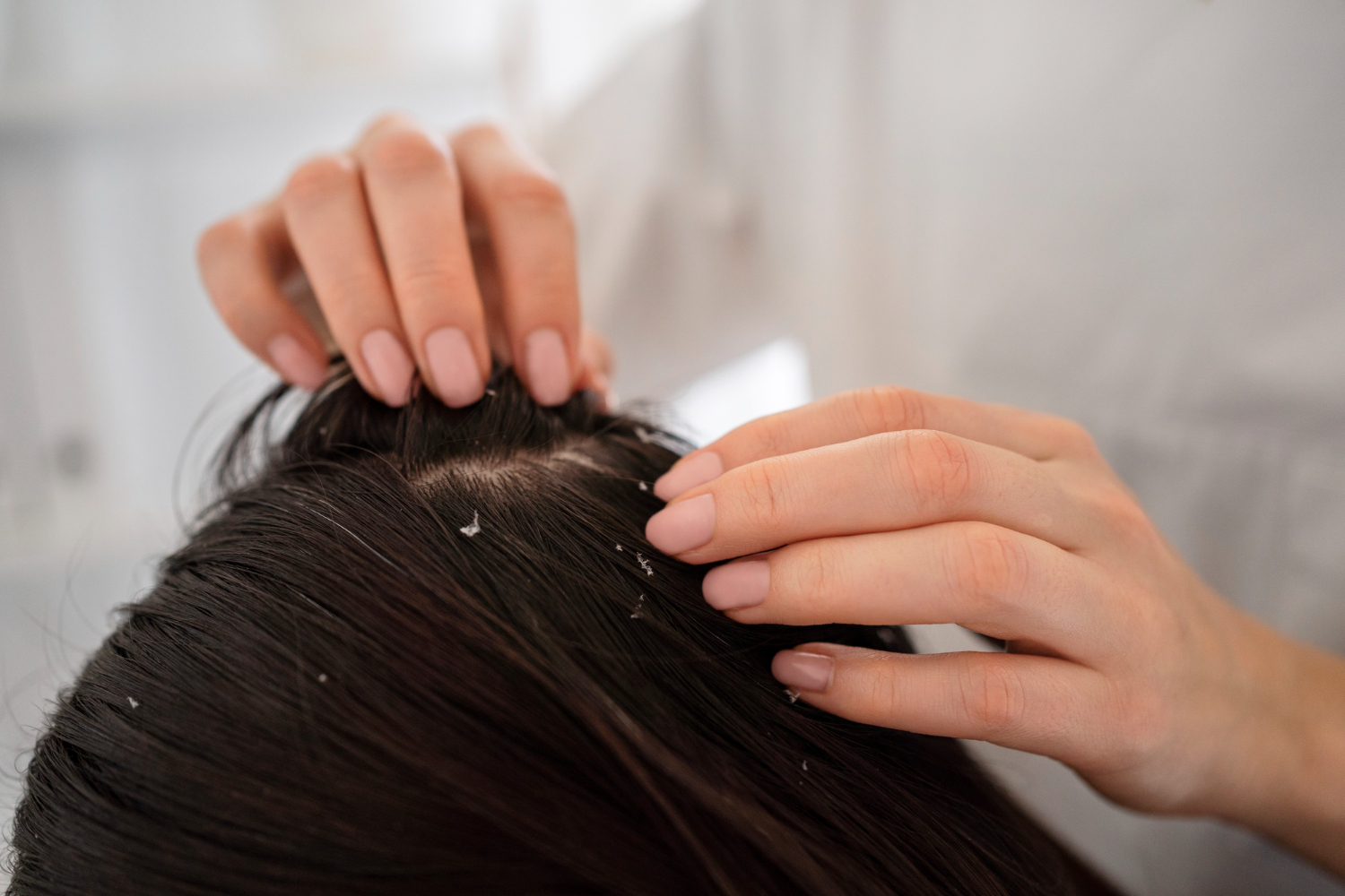 dandruff-treatment